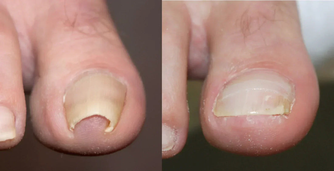 Before and after BS Brace treatment for ingrown toenail — hook-free nail correction results