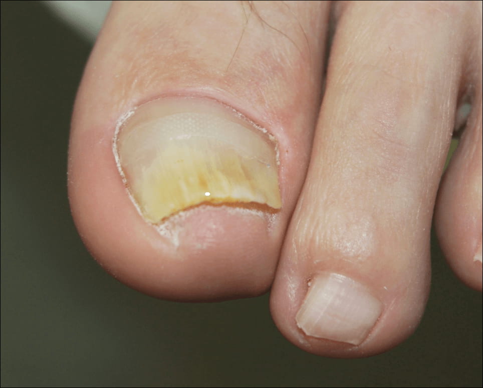 After treatment