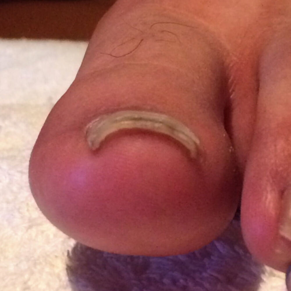 After treatment