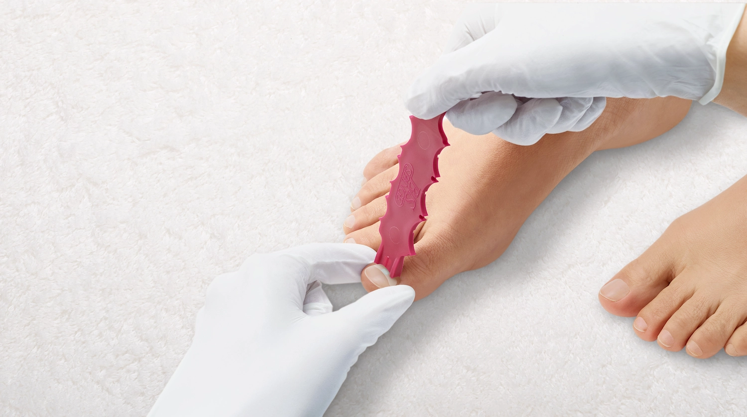 BS Brace ingrown toenail correction system