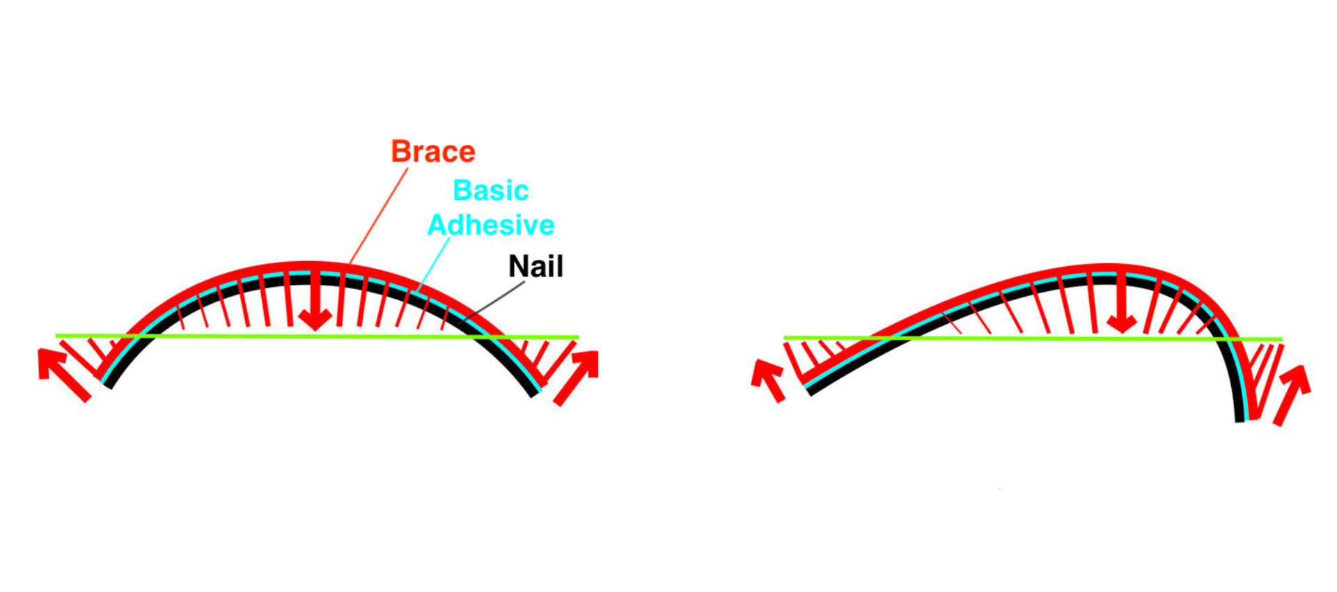BS Brace System