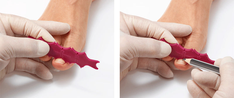 BS Brace ingrown toenail correction system