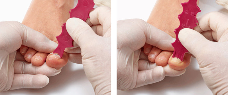 Podiatrist applying BS Brace treatment