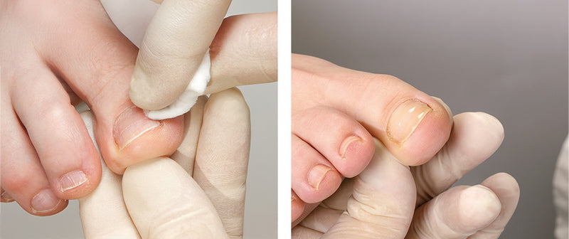 BS Brace ingrown toenail correction system